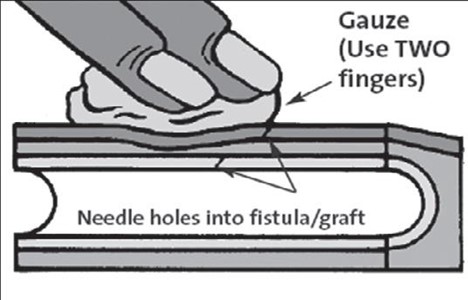 Use at least two fingers to hold gauze in place on the bleed. See further instructions below