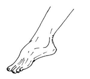 A drawn foot diagram of a foot with toes pointed downwards.