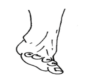 A drawn diagram of a foot with the foot being twisted inwards towards the body.